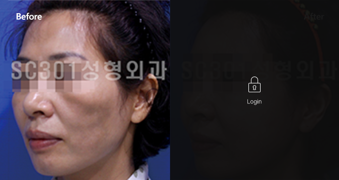 주름쳐짐 CASE