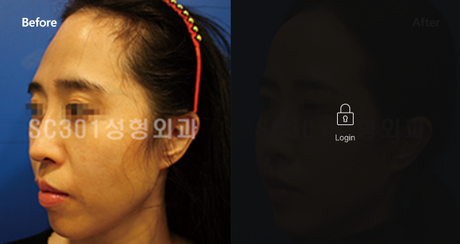 볼륨이 없는 얼굴형 CASE