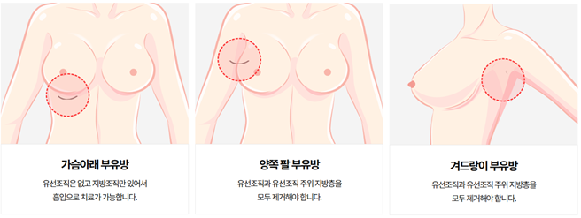 image-33 부유방 교정 수술, 단순 지방흡입과 다른 점