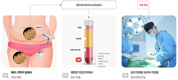 image-3 SVF 힙업성형 힙라인 관리