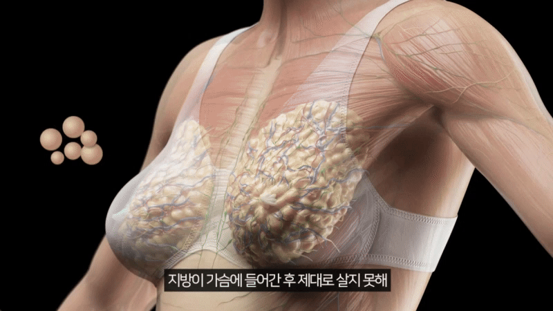 지방괴사현상 자가지방가슴성형 생착률, 병원마다 차이 나는 이유
