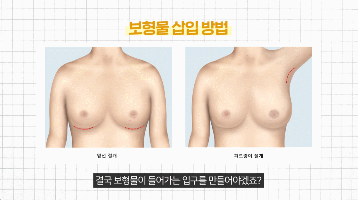 If you want natural-looking breasts after implant removal? Stem Cell (SVF) Breast Augmentation (Breast Fat Grafting)